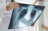 Minsa reporta baja en incidencia y muertes por tuberculosis durante el 2025