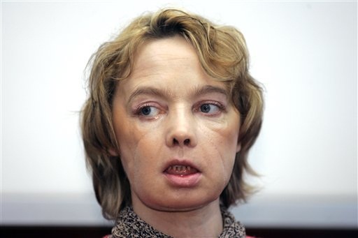 Isabelle Dinoire, recibió el primer trasplante parcial de cara del mundo con una nueva nariz, la barbilla y la boca, en una operación el 27 de noviembre de 2005.  /  Foto: AP