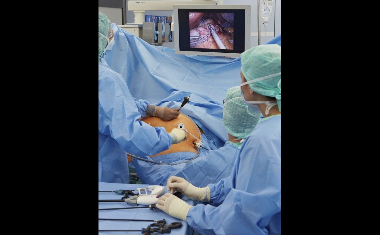 Como resultado de la cirugía el paciente come menos y, al mismo tiempo, absorbe menos del alimento que ha ingerido. Foto: EFE Salud / Archivo