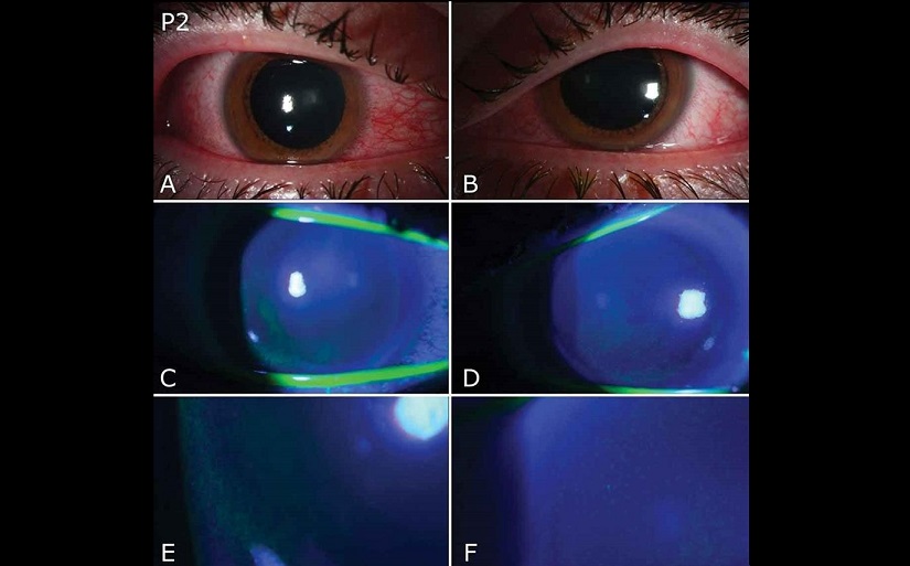 25/11/2020 02:59 (UTC) Autor: EFEI0499 Temática: Sanidad y salud » Sanidad Sanidad y salud » Enfermedades » Enfermedades contagiosas Imagen cedida por la Universidad de Miami de una fotografía con lámpara de hendidura de ambos ojos de un paciente (P2) con