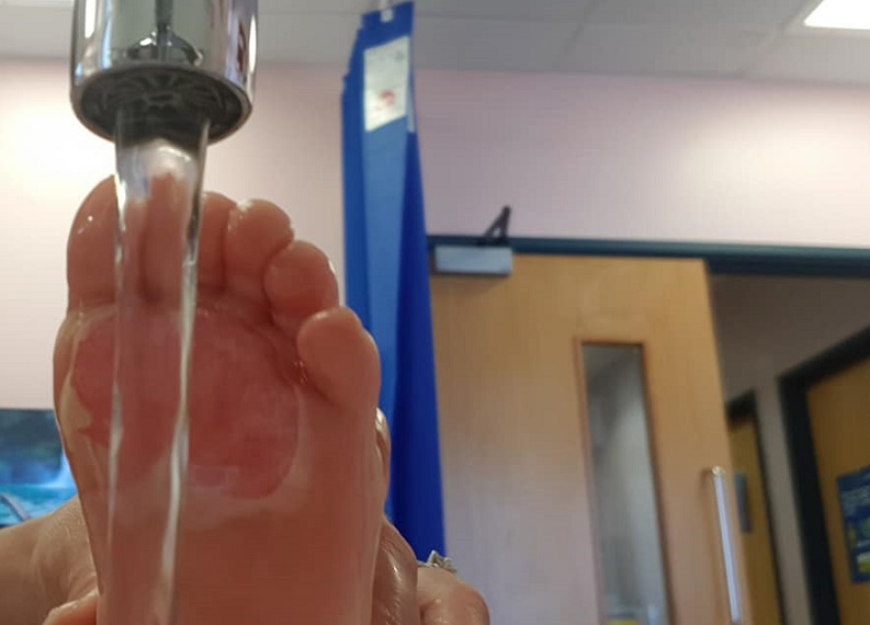 El pequeño quedó con las plantas de sus pies totalmente enrojecidas por pisar el piso caliente de la cocina. Foto: Facebook