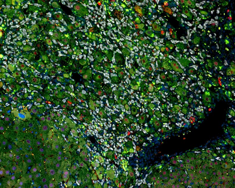 Imagen de un hígado de ratón con cirrosis en la que distintos tipos de células del hígado han sido marcadas con fluoróforos que se distinguen en los colores blanco, verde y rojo