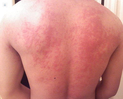 Los 6 estudiantes afectados presentaron síntomas de enrojecimiento en la piel y picazón.  (Foto:Ilustrativa)