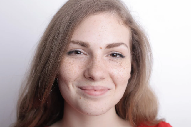 Las manchas cutáneas, según la OMS, son un problema de salud significativo que puede causar sufrimiento, estigma y discapacidad. Foto: Pexels