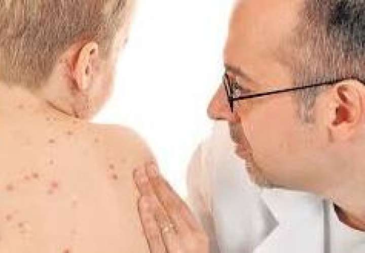 A inicio de marzo se realizará un jornada de vacunación para niños no vacunados contra la enfermedad.