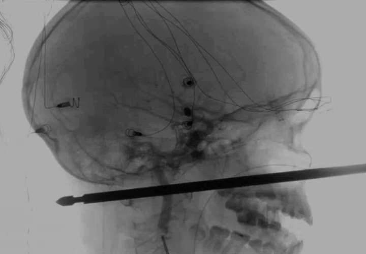 Foto del Medical News Network muestra el resultado de unos rayos X en la cual se ve una brocheta atravesada en la cabeza del niño Xavier Cunningham. AP
