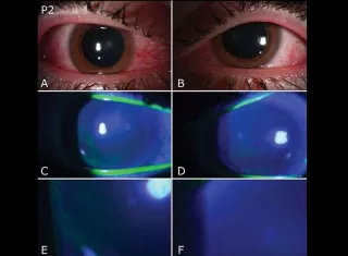 25/11/2020 02:59 (UTC) Autor: EFEI0499 Temática: Sanidad y salud » Sanidad Sanidad y salud » Enfermedades » Enfermedades contagiosas Imagen cedida por la Universidad de Miami de una fotografía con lámpara de hendidura de ambos ojos de un paciente (P2) con