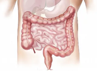 El cáncer colorrectal es el cuarto cáncer más común en la región de las Américas, según la Organización Panamericana de la Salud (OPS). Foto ilustrativa / Pixabay.