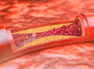 Vista de una arteria engrosada. Imagen ilustrativa