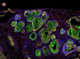 En la imagen, inmunofluorescencia de un tumor de páncreas, con esa proteína en verde. Imagen Bruno Sainz / EFE