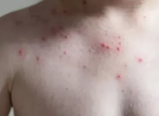 Las autoridades sanitarias destacaron que en Panamá no existe circulación endémica del virus. Foto: Cortesía