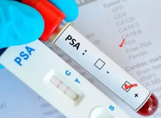 La prueba de sangre es válida, pero el peligro de los falsos positivos está a la orden del día. Un marcador alterado puede desatar un verdadero calvario emocional en el paciente si no se interpreta con rigor clínico.