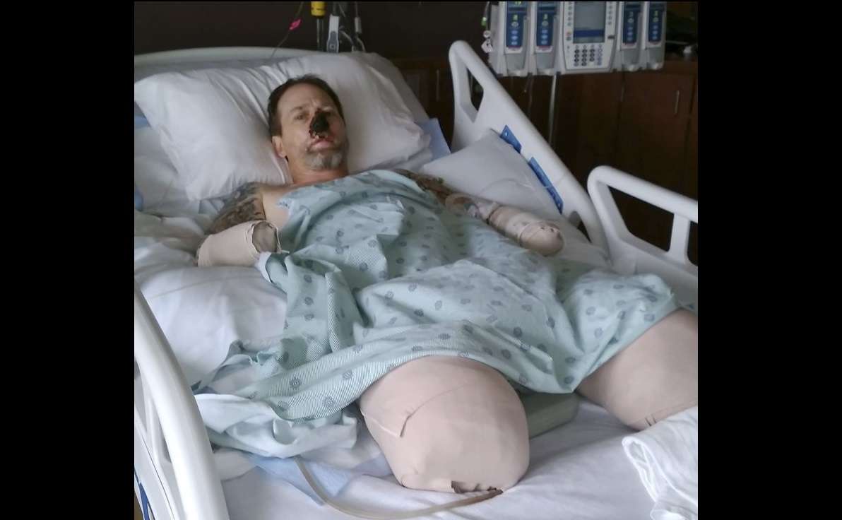 Greg Manteufel, de 48 años, acudió a una clínica del área de Milwaukee con síntomas similares a los de una gripe y ha estado hospitalizado desde fines de junio. AP