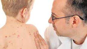 A inicio de marzo se realizará un jornada de vacunación para niños no vacunados contra la enfermedad.