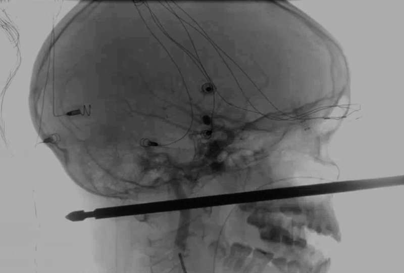Foto del Medical News Network muestra el resultado de unos rayos X en la cual se ve una brocheta atravesada en la cabeza del niño Xavier Cunningham. AP