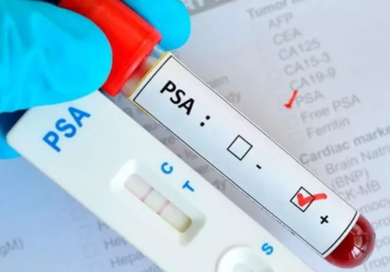 ¡Alerta con el  PSA! Minsa aclara el miedo que paraliza a miles de hombres 