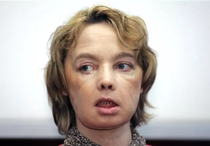 Isabelle Dinoire, recibió el primer trasplante parcial de cara del mundo con una nueva nariz, la barbilla y la boca, en una operación el 27 de noviembre de 2005.  /  Foto: AP