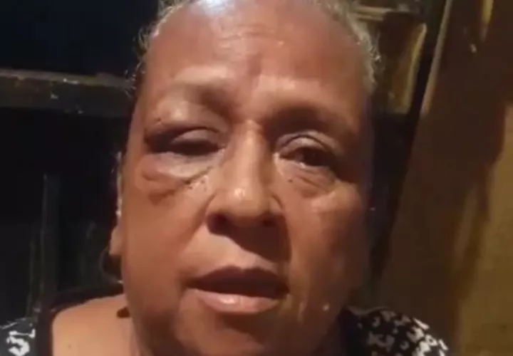 Esta señora fue agarrada a pedradas el lunes por el sujeto, quien le rompió la cara y le dejó un ojo morado.  Foto Mayra Madrid Corresponsal