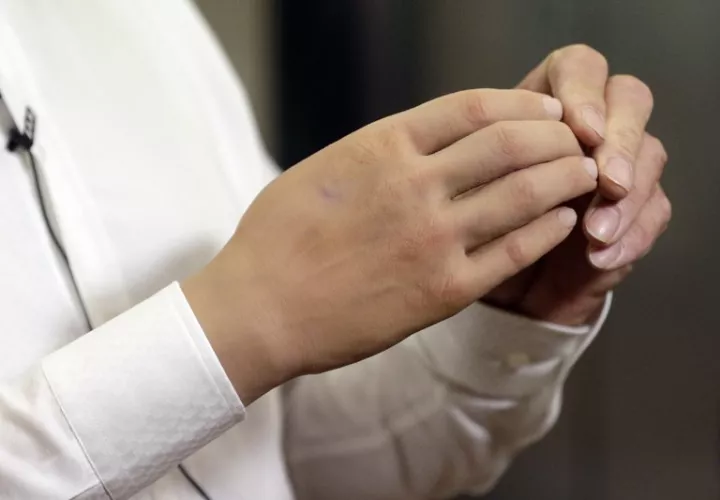 La mano robótica de Hennes tiene un diseño mecánico más simple en comparación con otras prótesis mioeléctricas. Foto: AP