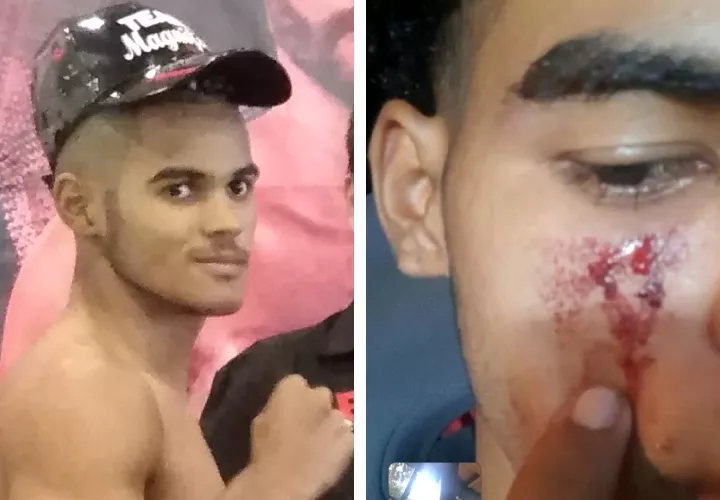 José Núñez. a la derecha la herida que tuvo durante el incidente con los antisociales. Foto; Cortesía