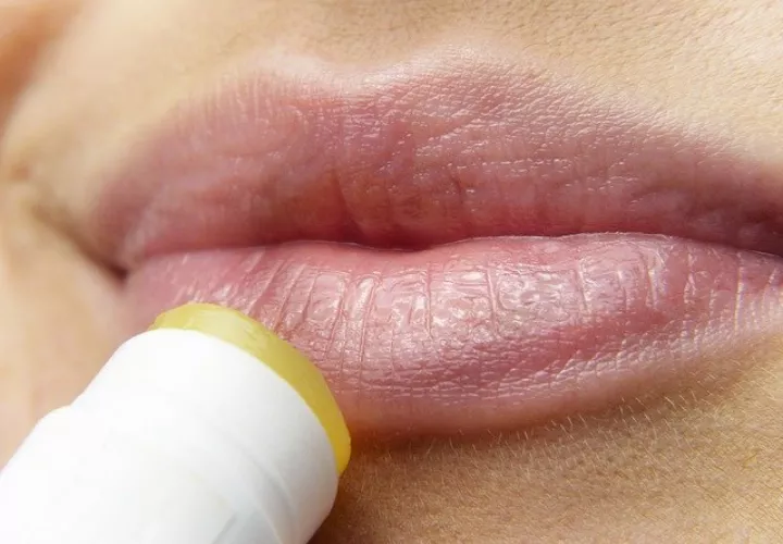 El herpes labial se suele contagiar por el contacto bucal. Imagen ilustrativa Pixabay