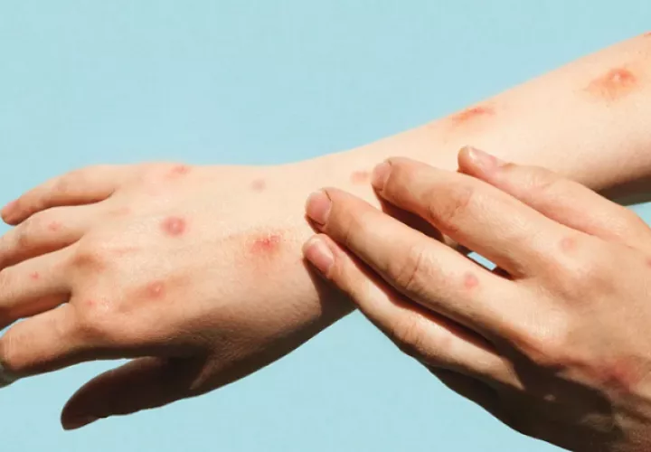 Paciente contagiado con viruela del mono presenta lesiones en ambas manos. Imagen OPS