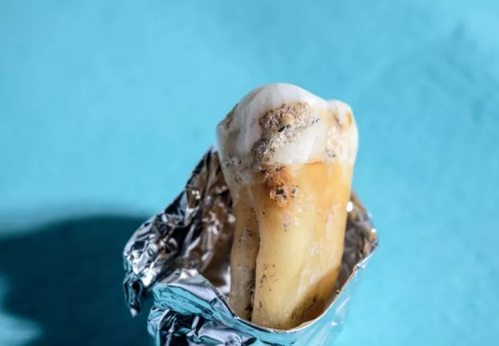 El cálculo dental (sarro de los dientes) conserva el ADN durante milenios, lo que proporciona información sin precedentes sobre la biodiversidad y las capacidades funcionales de los antiguos microbios. EFE / Fundación Werner Siemens