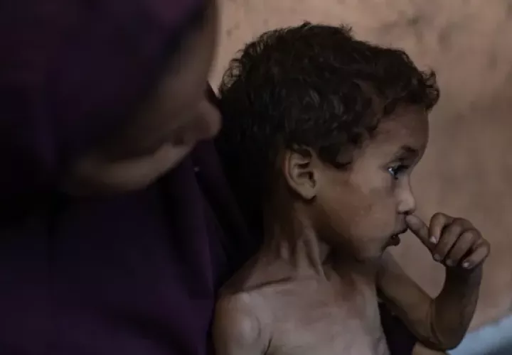 Un niño de dos años con problemas de desnutrición en Gaza. Foto: EFE