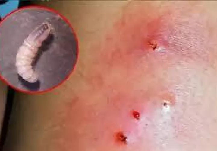 En alerta en Coclé por la enfermedad.