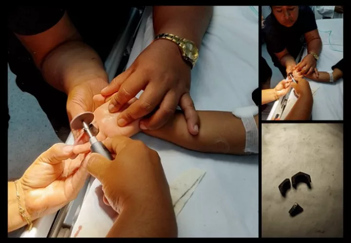 La situación ameritó una cirugía ambulatoria.  /  Fotocompocisón: BCBRP