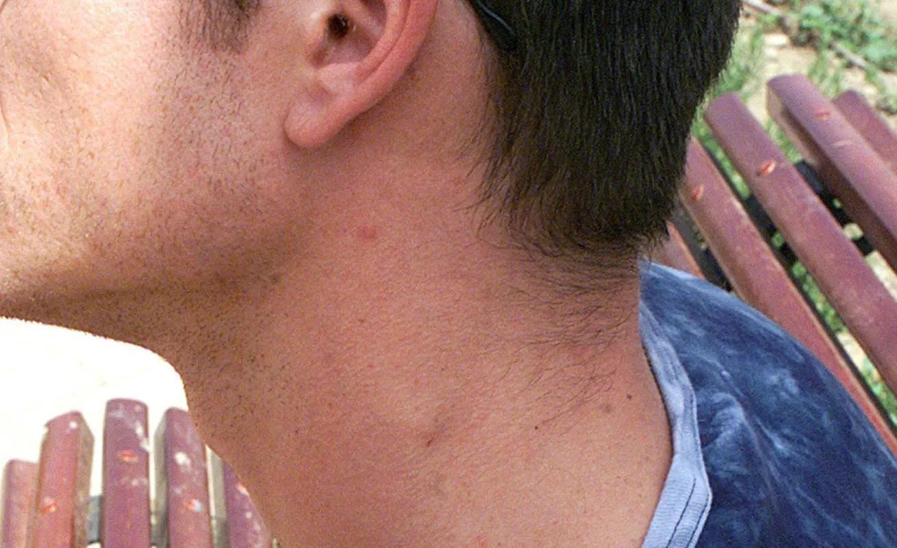 ¿Qué es este bulto que tengo en el cuello?